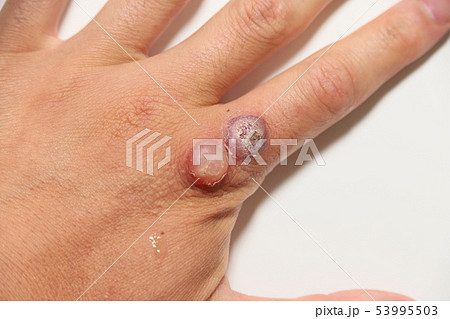 ウイルス性いぼの治療 ウイルス性いぼの治療 53995503