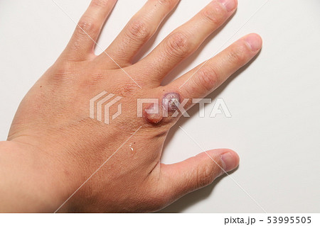 ウイルス性いぼの治療 53995505