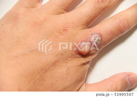 ウイルス性いぼの治療 53995507