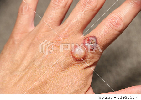 ウイルス性いぼの治療 53995557