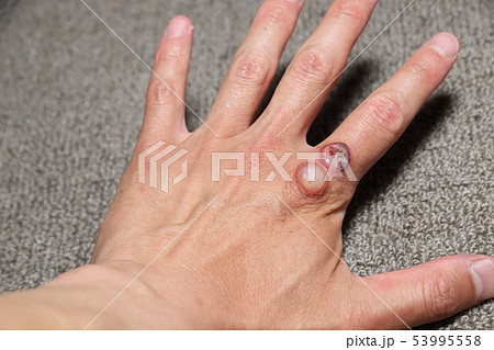 ウイルス性いぼの治療 53995558