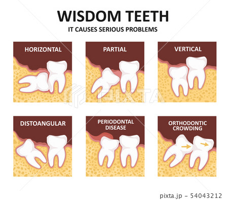 Wisdom tooth. Possible problems because of the third molar 54043212
