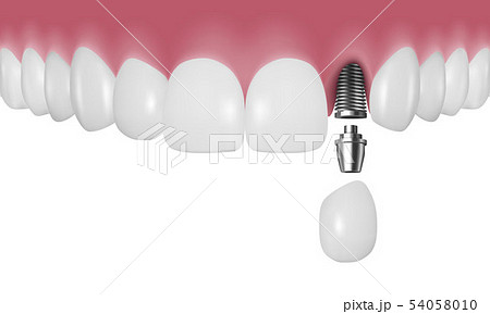 Vector 3d Realistic Render Human Teeth with Implant Closeup Isolated on White Background. Dentistry 54058010