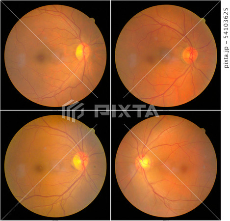 retinal images 54103625
