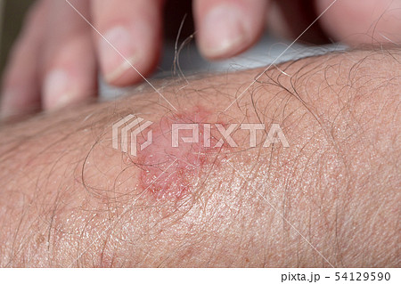 eczema on the arm of a man eczema on the arm of a man 54129590