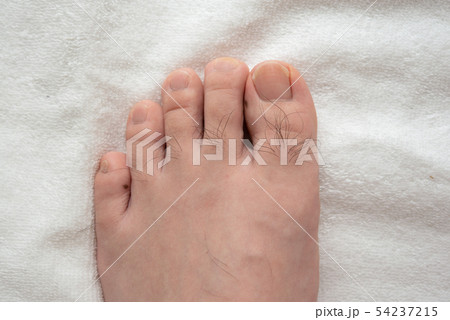 メンズ 足指脱毛 beforeイメージ メンズ 足指脱毛 beforeイメージ 54237215