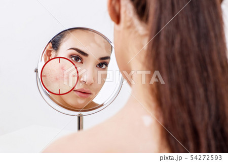 Young woman with acne skin in red aim. 54272593