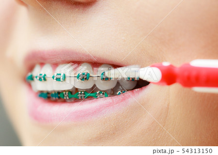 interdental brush for braces