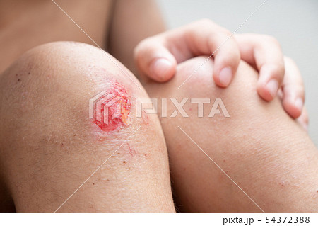 子供の膝の怪我の写真素材
