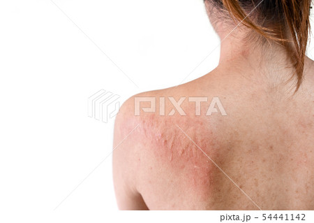 Back of young asian woman have itchy with allergy Back of young asian woman have itchy with allergy 54441142