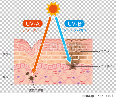 皮膚圖紫外線傷害 54505401