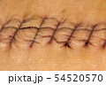 suture macro 54520570