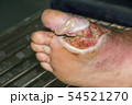 wound of diabetic foot 54521270