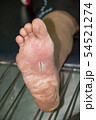wound of diabetic foot 54521274