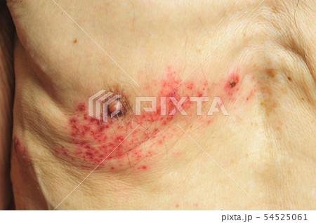 Shingles is a viral infection that causes a painfu Shingles is a viral infection that causes a painfu 54525061