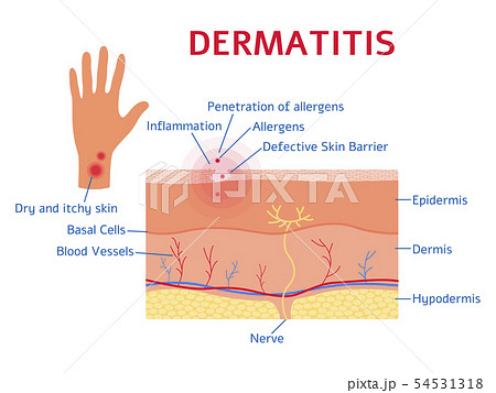 Dermatitis graphic diagram or scheme flat style 54531318