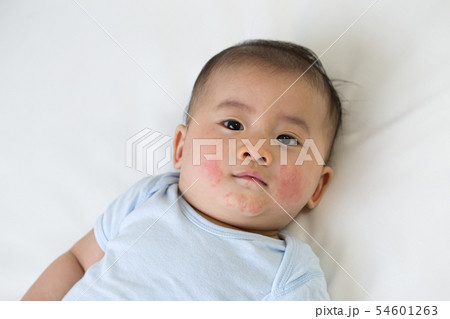 Asian baby boy lying on the bed and had a red rash 54601263