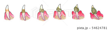 犬の歯 歯石の付着と歯周病のイラスト素材