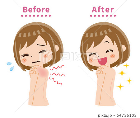 背中　かゆみ　ビフォー　アフター 54756105