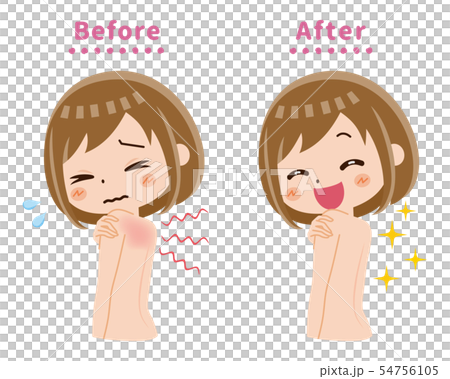 背中　かゆみ　ビフォー　アフター 54756105