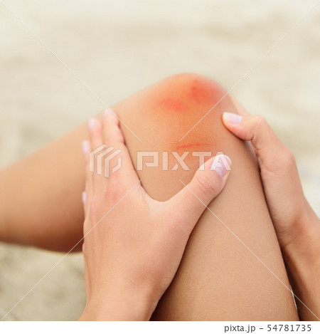 Woman nursing a bruised grazed knee 54781735