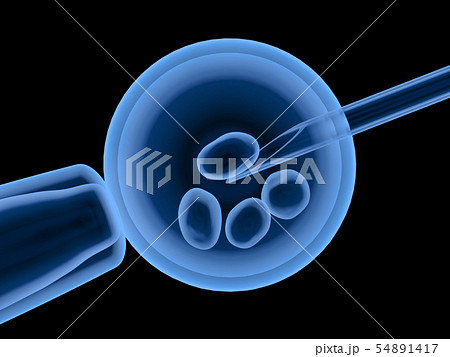 artificial insemination or ivf 54891417