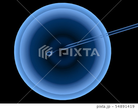 artificial insemination or ivf 54891419