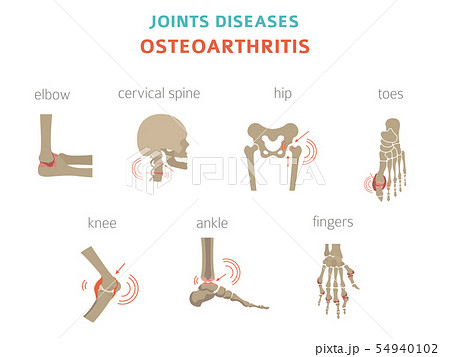 Arthritis, osteoarthritis medical infographic 54940102