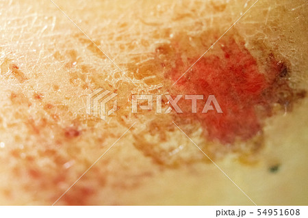 Lesion on knee. Scraped knee. Broken bleeding knee Lesion on knee. Scraped knee. Broken bleeding knee 54951608