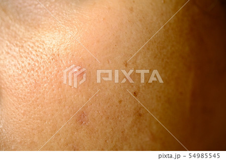 Inflammatory acne on the face of women. Inflammatory acne on the face of women. 54985545