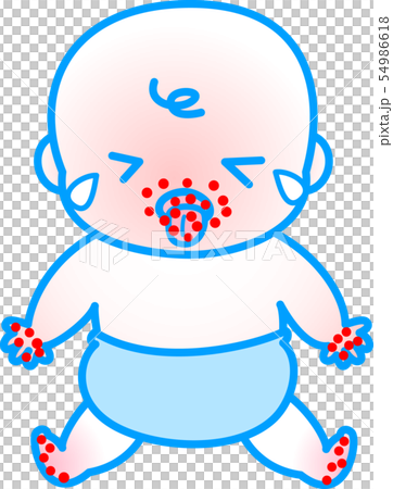 手足口病　赤ちゃん 54986618