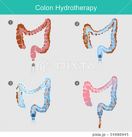 Colon Hydrotherapy.The secreted of waste that 54986945