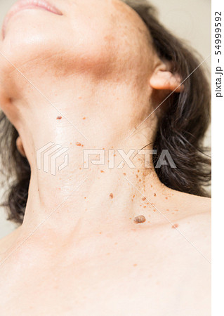 老人性イボ 首イボ 老人性イボ 首イボ 54999592