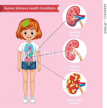 Scientific medical illustration of kidney disease 55036884