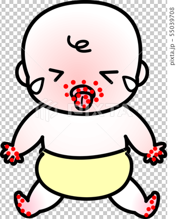 手足口病寶寶 55039708