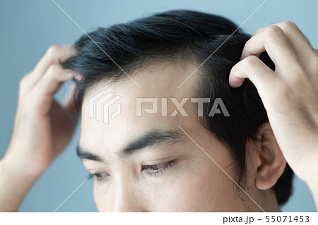 Young man serious hair loss problem for health 55071453