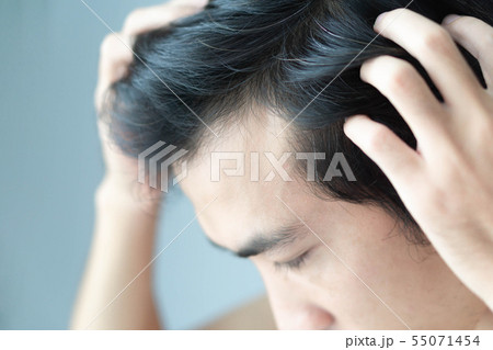 Young man serious hair loss problem for health 55071454