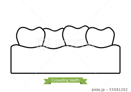 crowding teeth ( malocclusion ) crowding teeth ( malocclusion ) 55081202