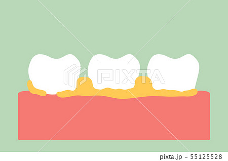 periodontal disease with dental plaque or tartar 55125528