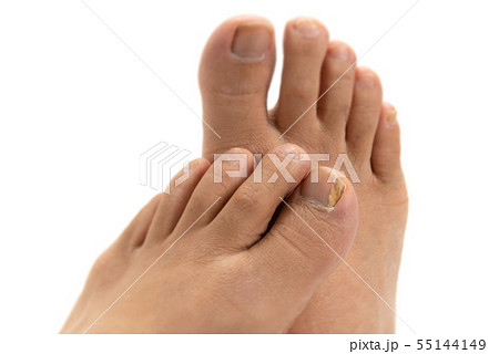 男性の足の爪水虫 55144149