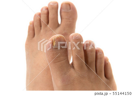 爪水虫 55144150