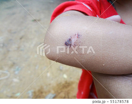Wound on the elbow of a child Caused by accidents Wound on the elbow of a child Caused by accidents 55178578