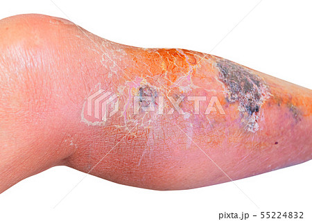 Erysipelas bacterial infection Under skin leg Erysipelas bacterial infection Under skin leg 55224832