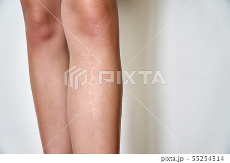 The scar on the leg. Bone fracture or tumor removal. Recobvery. isolated medical on white background 55254314