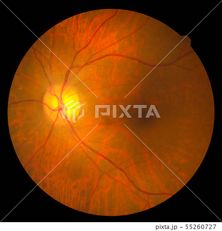 retinal 55260727