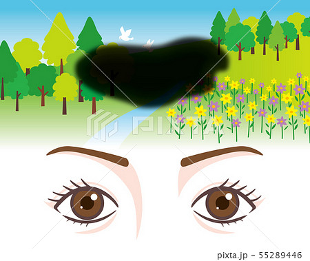 目の症状　視野の欠如 55289446