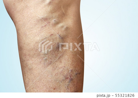 Varicose veins on a female legs. Phlebology Varicose veins on a female legs. Phlebology 55321826