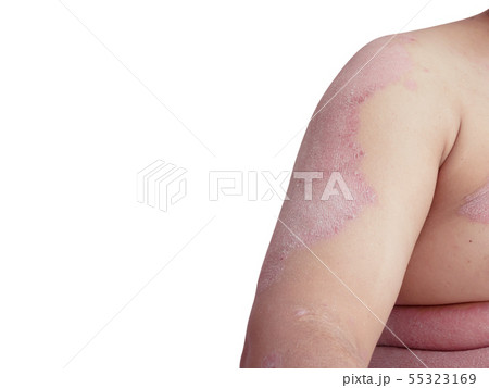 Diseases caused by abnormalities of the lymph Diseases caused by abnormalities of the lymph 55323169