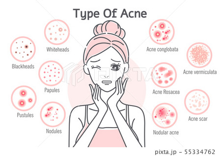 skin care type of acne 55334762