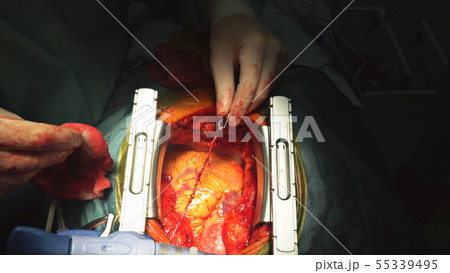 Heart surgery. Open heart surgery suture greater Heart surgery. Open heart surgery suture greater 55339495